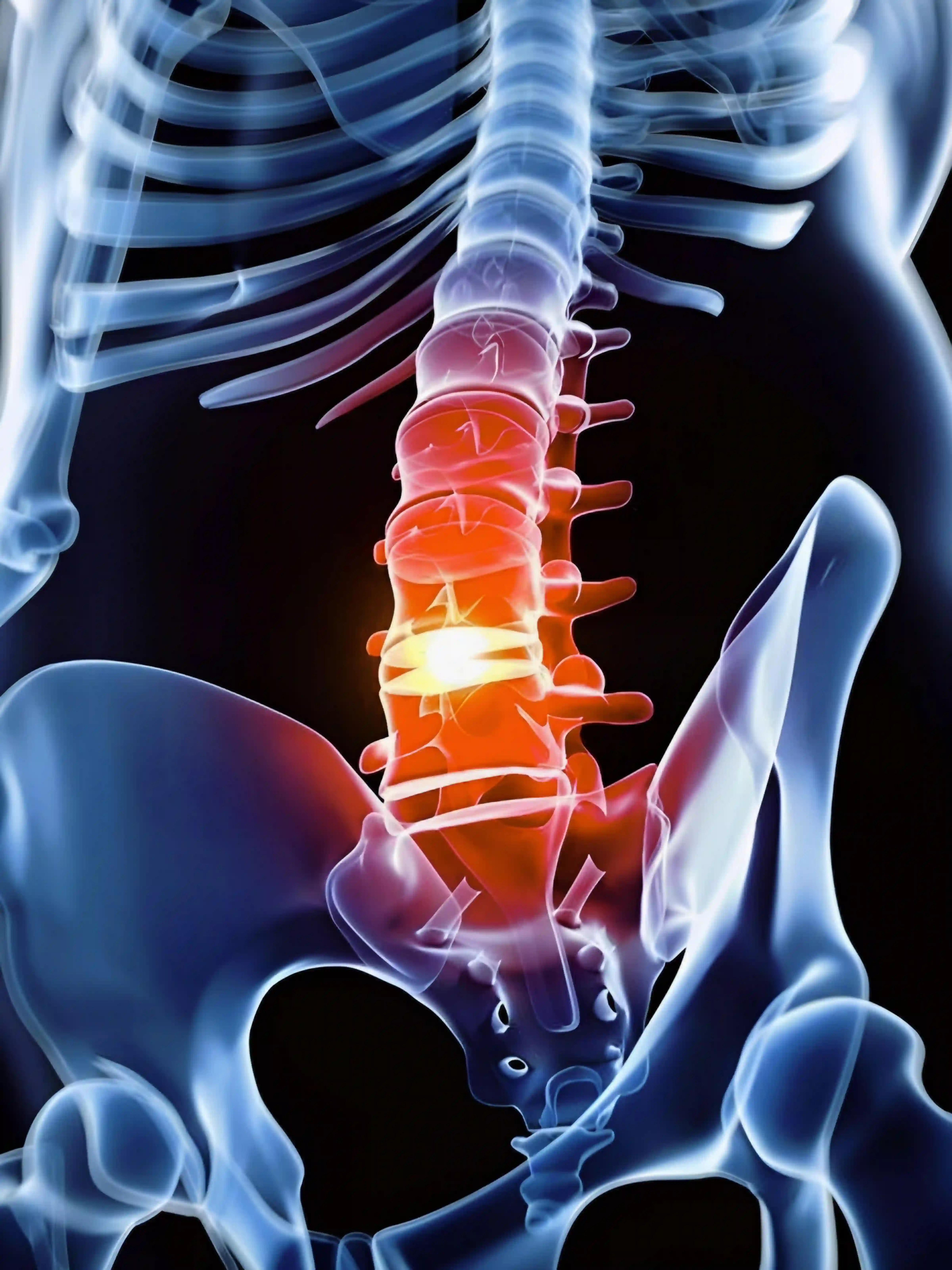 Slip Disc / Disc Prolapse